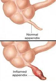 First Successful Appendectomy