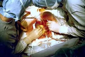 First Open Heart Surgery