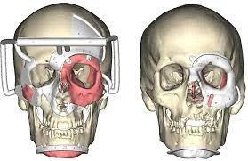 Whole Eye Transplant