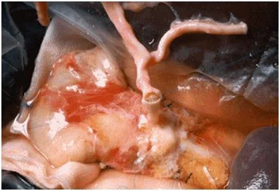 Noiz izan zen lehen pankreako transplanteak ?