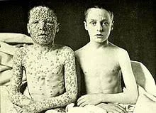 Smallpox Epidemic