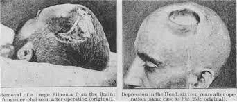 First brain tumor removal