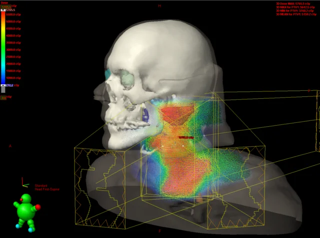 Radioterapia de intensidad modulada