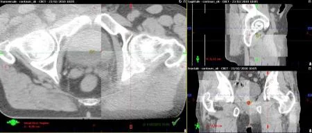 Radioterapia guiada por imagen