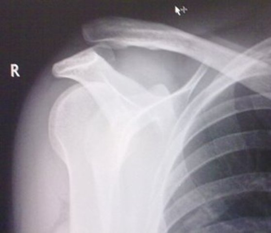 Dislocated Clavicle