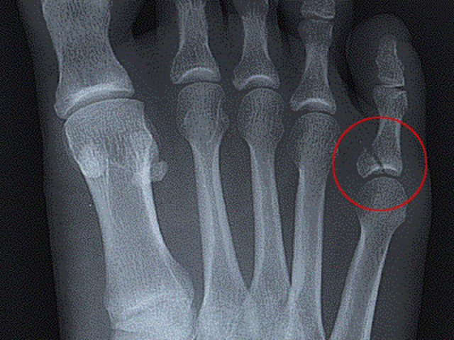 My fractured foot