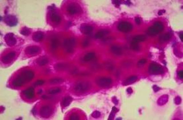 Cervical cancer