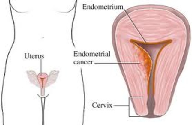 Endometrial Cancer
