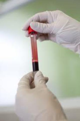 Prostate-Specific Antigen Test