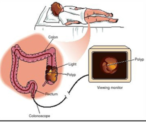 Colorectal Cancer