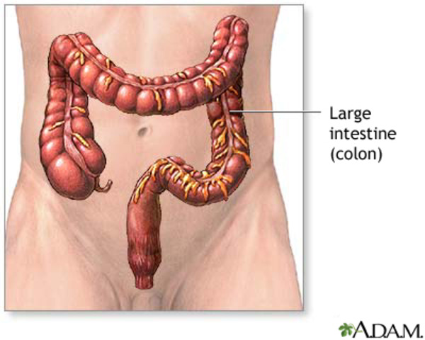 Colorectal cancer