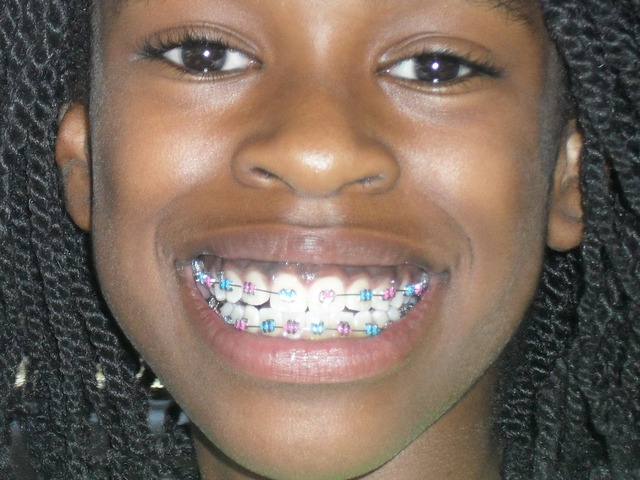Me getting braces for the first time