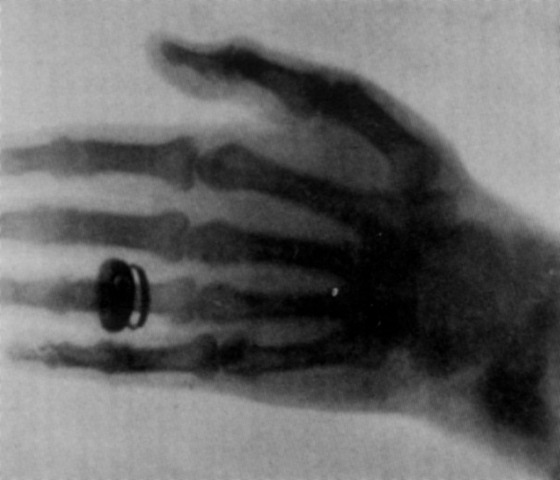 Ακτινιγραφία