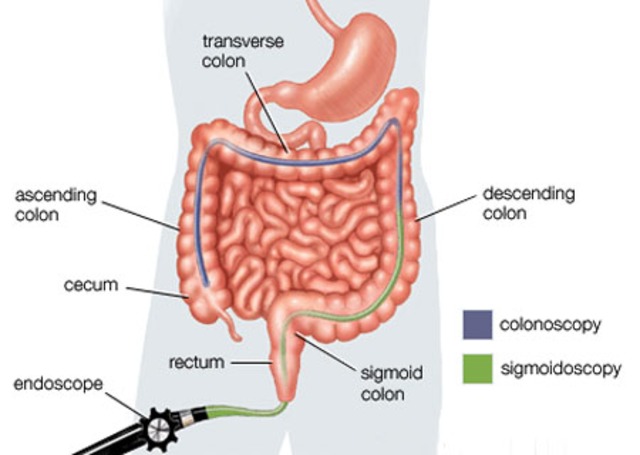 Colonoscopy and Flexible Sigmoidoscopy