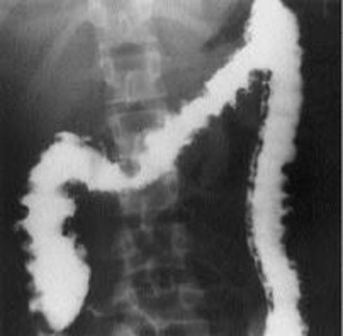 Barium Enema