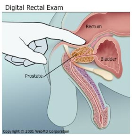 Digital Rectal Exam
