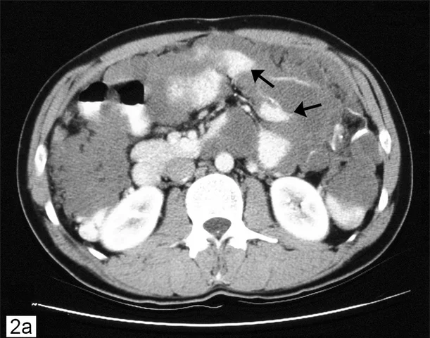 Diagnosed with Abdominal Cancer