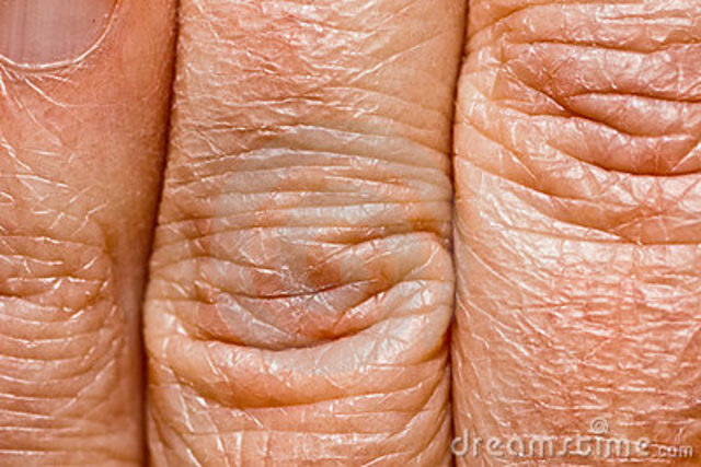 skin bcome wrinkled