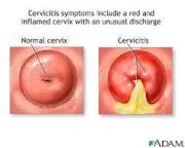 Cervical Cancer