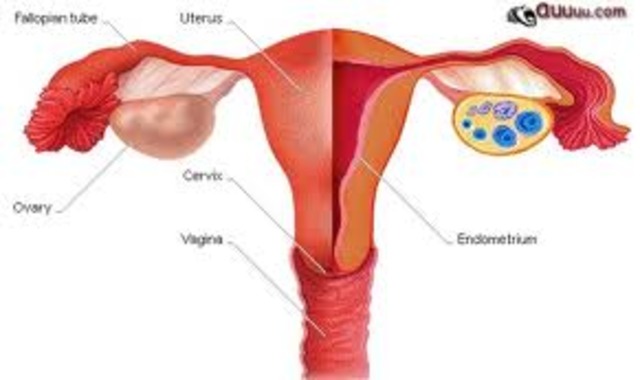 Uterine Cancer