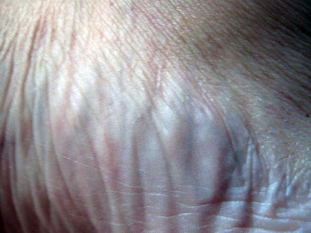Skin starts to become wrinkled.