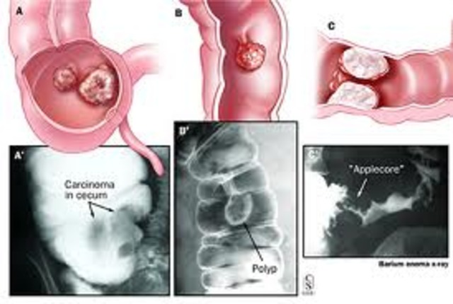 Double-Contrast Barium Enema