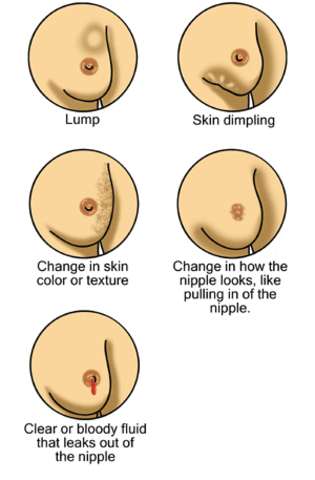Breast Self-Exam