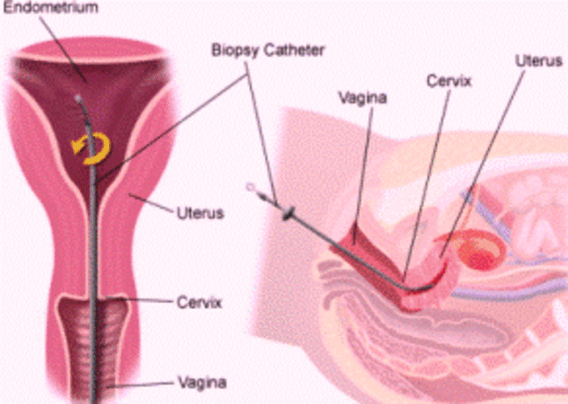 Endometrial Biopsy