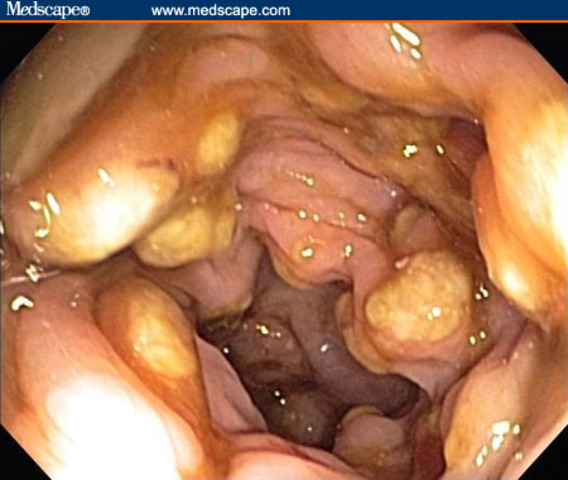 Flexible sigmoidoscopy