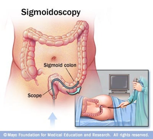 Flexible Sidmoidoscopy