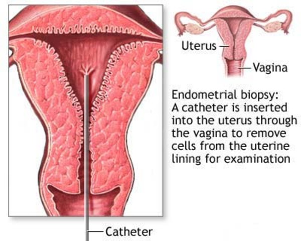 Endometrial Biopsy