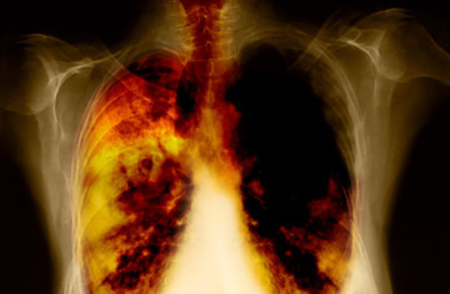 Lung Screening