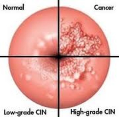 Cervical Cancer