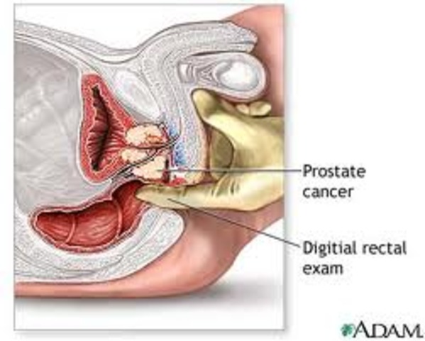 Prostate Cancer