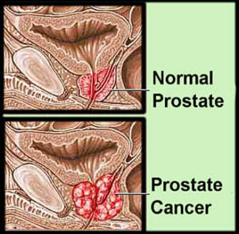 Prostate cancer