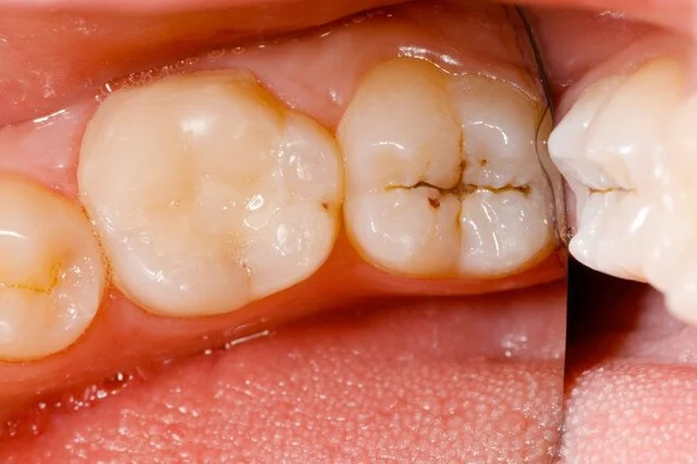 Origen de Caries Dentales