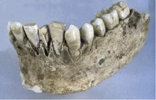 Primera prótesis dental