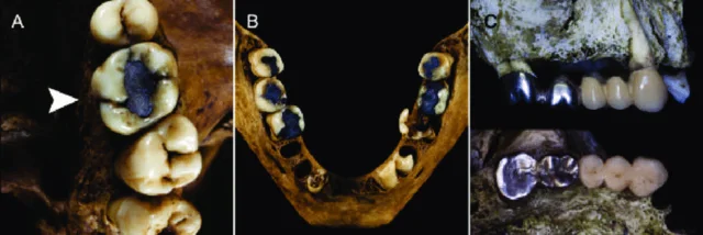 Creación de amalgama dental