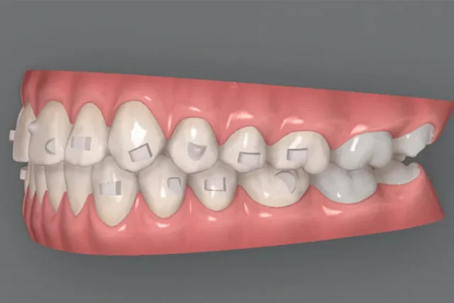 Creación de ataches dentales