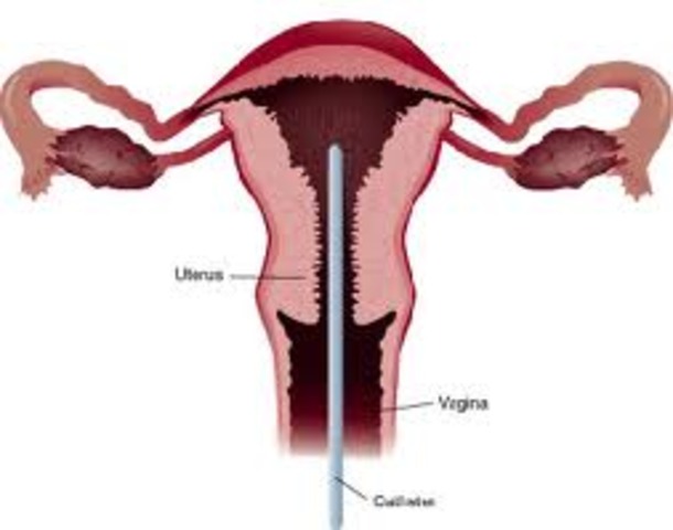 Endometrial Biopsy