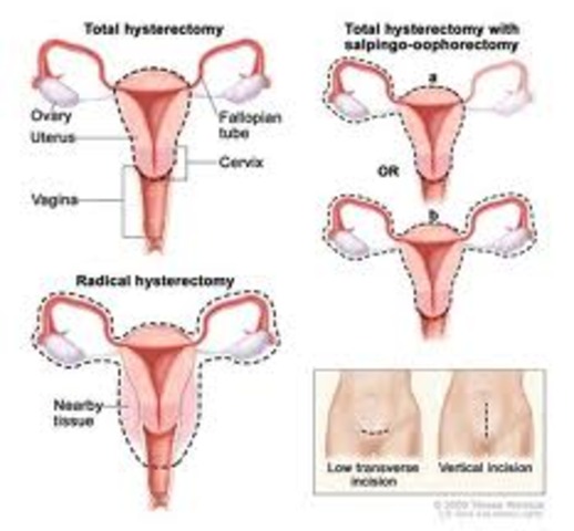 Endometrial Cancer (menopause)