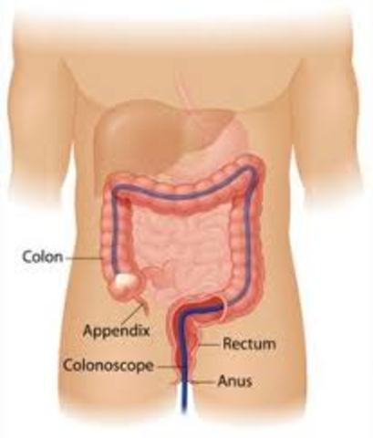 Colon Cancer-Age 50
