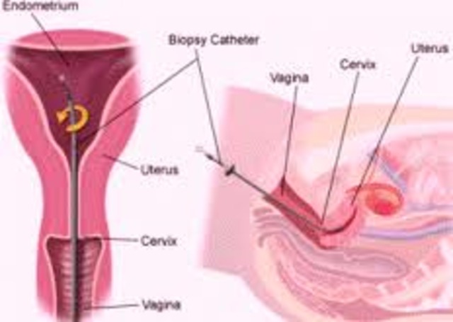 Endometrial Cancer