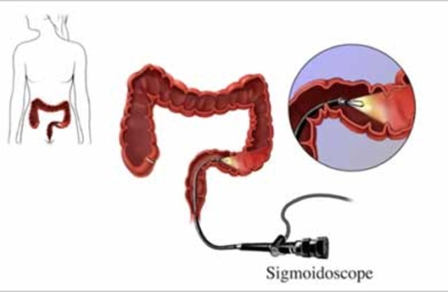 Flexible sigmoidoscopy every 5 years