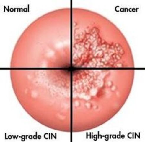 begin cervical cancer screening