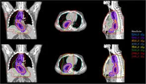 Intensity-modulated radiation therapy (IMRT)
