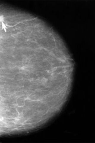 yearly mammogram
