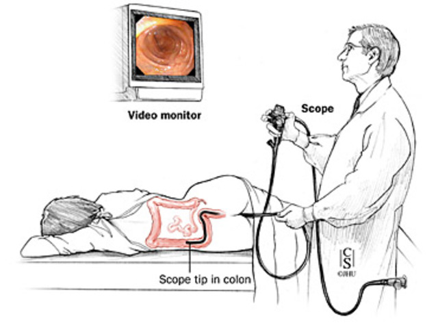 Flexible Sigmoidoscopy