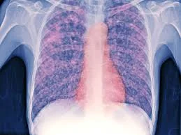 Tuberculosis