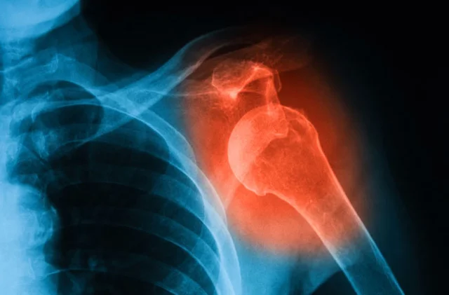 I dislocate my left elbow
